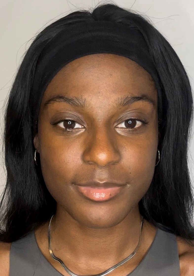 SHEI - SALMON DNA FACIAL - AFTER